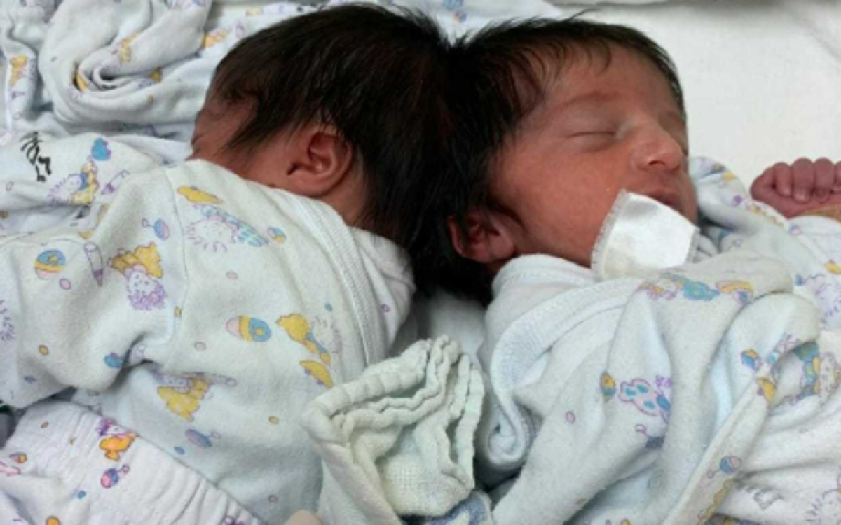 «По две головы»: в Израиле впервые разделили головы сиамских близнецов (фото, видео)